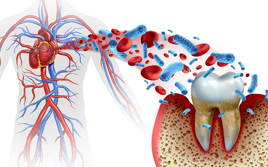 歯周病と全身疾患