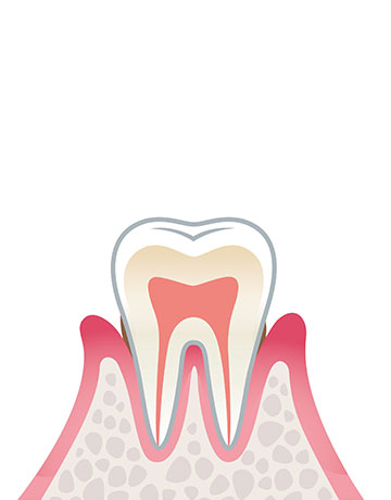 歯周炎（軽度）