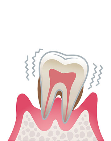 歯周炎（重度）